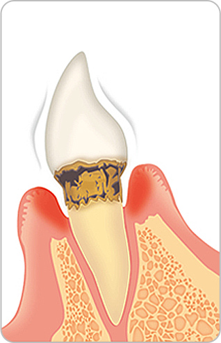 歯周病治療の画像